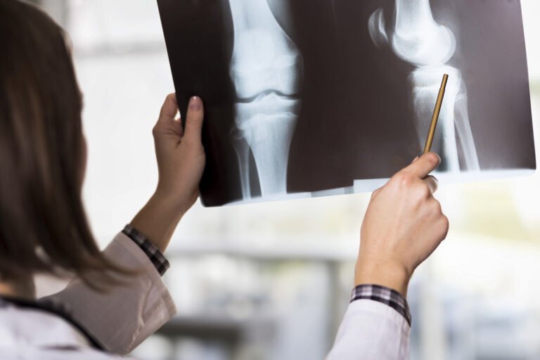 Prevenir la osteoporosis es posible